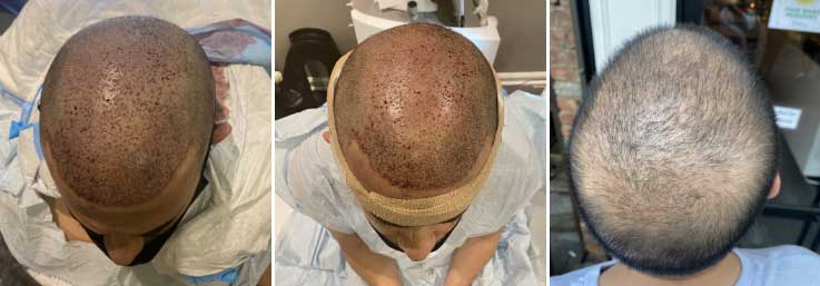 FUE hair transplant procedure Chester new jersey